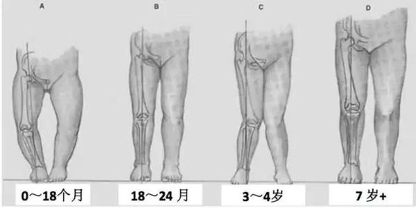 儿童腿型发育过程图图片